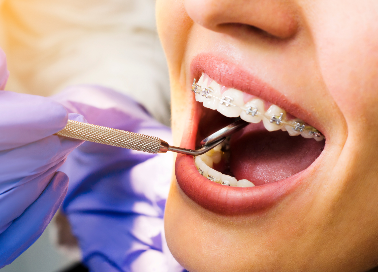 Comprehensive Guide to Braces Cost and Orthodontic Treatments in Ontario