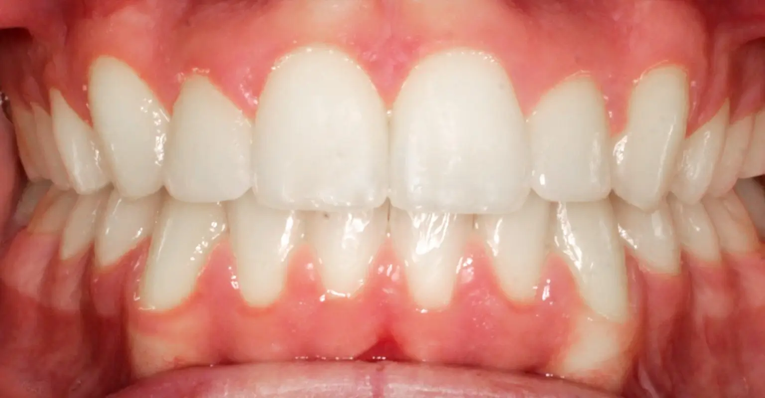 west-springs-orthodontist-airdrie-orthodontist-braces-after