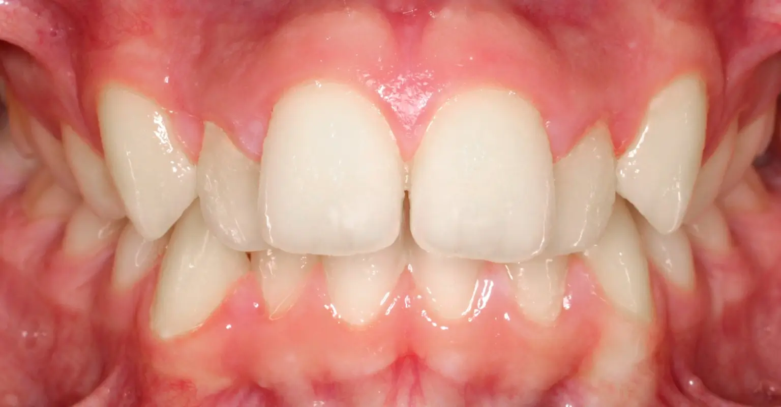 west-springs-orthodontist-airdrie-orthodontist-braces-before