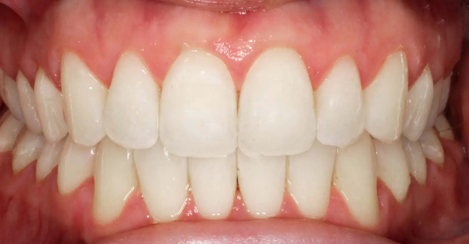 west-springs-orthodontist-airdrie-orthodontist-adult-orthodontics-after-v2