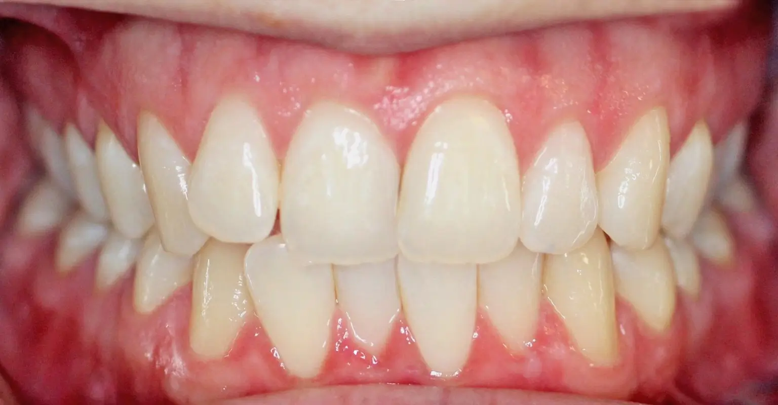 west-springs-orthodontist-airdrie-orthodontist-adult-orthodontics-before-v2