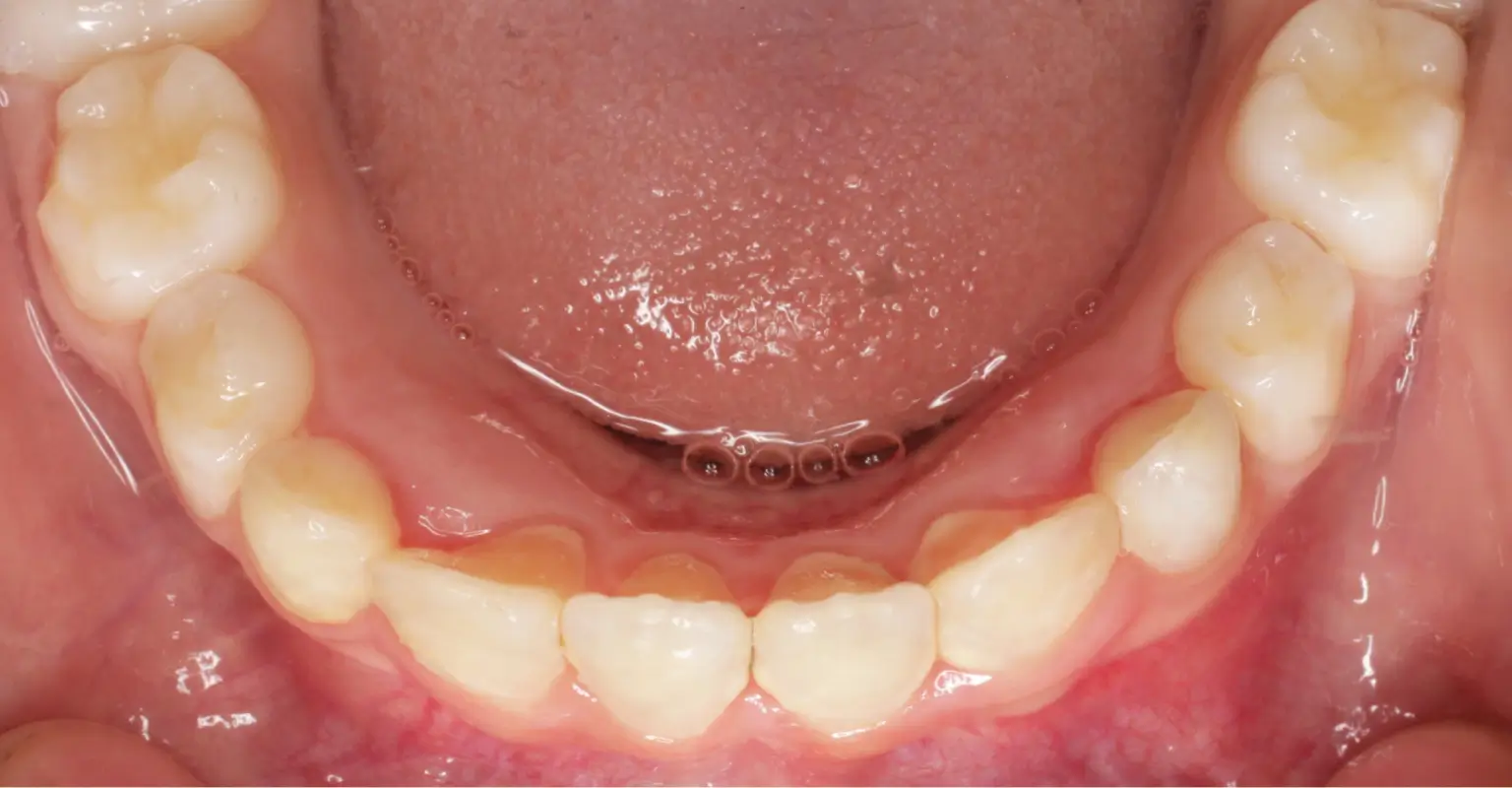 west-springs-orthodontist-airdrie-orthodontist-growing-patients-after