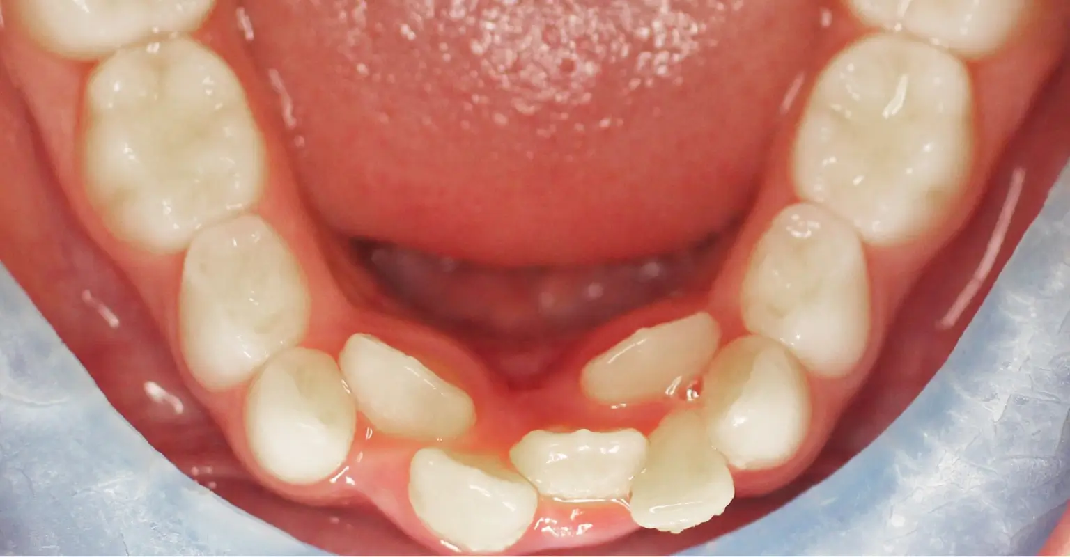 west-springs-orthodontist-airdrie-orthodontist-growing-patients-before