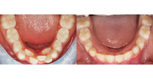 west-springs-orthodontist-airdrie-orthodontist-growing-patients-img
