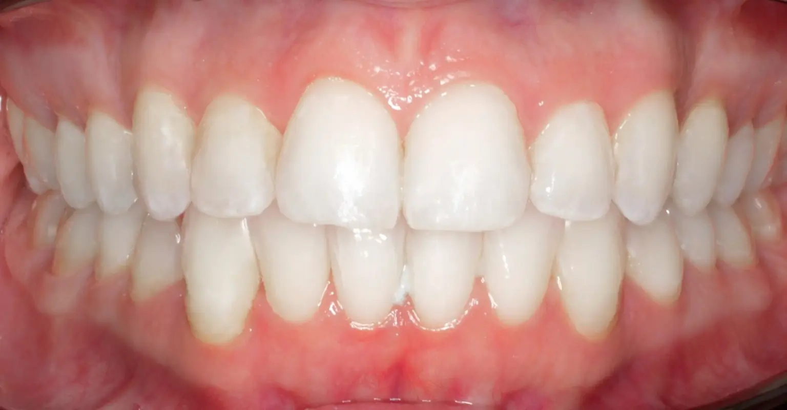 west-springs-orthodontist-airdrie-orthodontist-invisalign-after