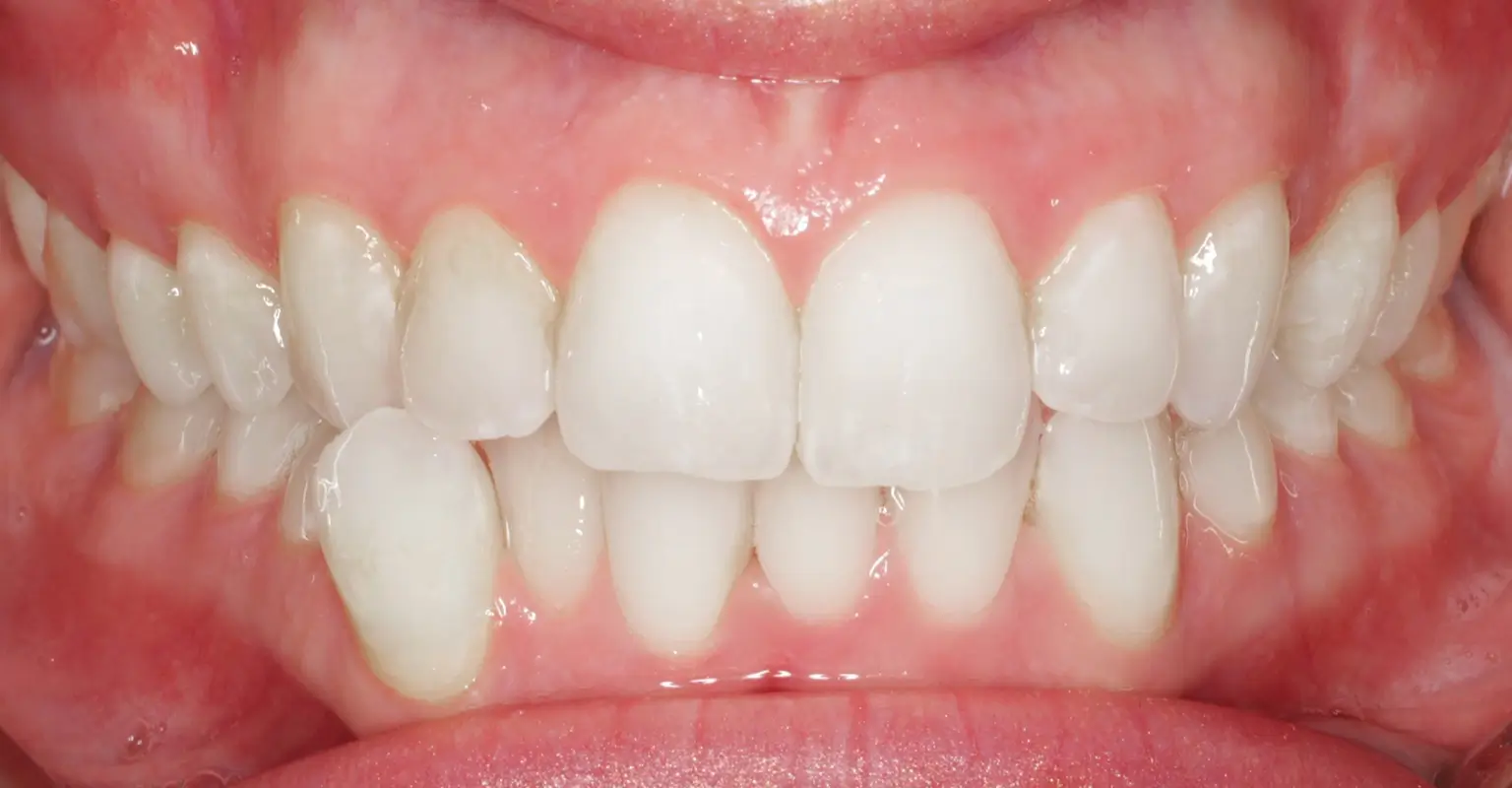 west-springs-orthodontist-airdrie-orthodontist-invisalign-before