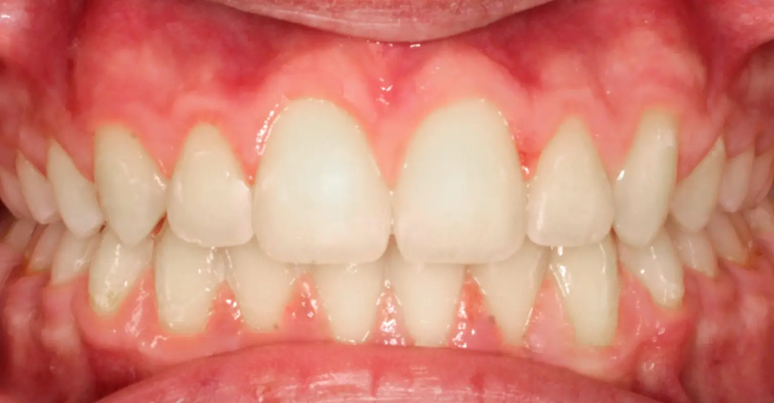 west-springs-orthodontist-airdrie-orthodontist-result-1-after