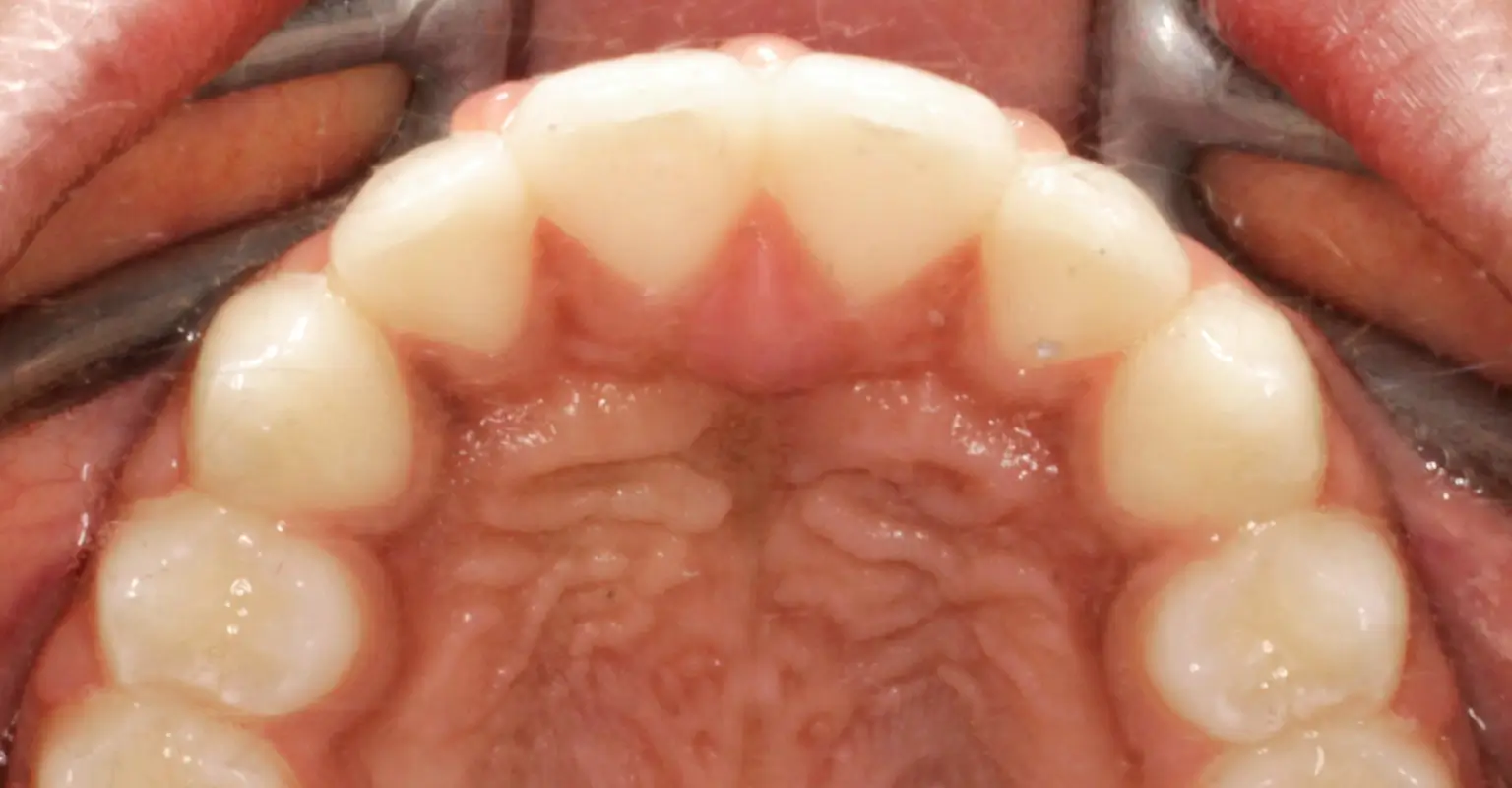 west-springs-orthodontist-airdrie-orthodontist-result-5-after