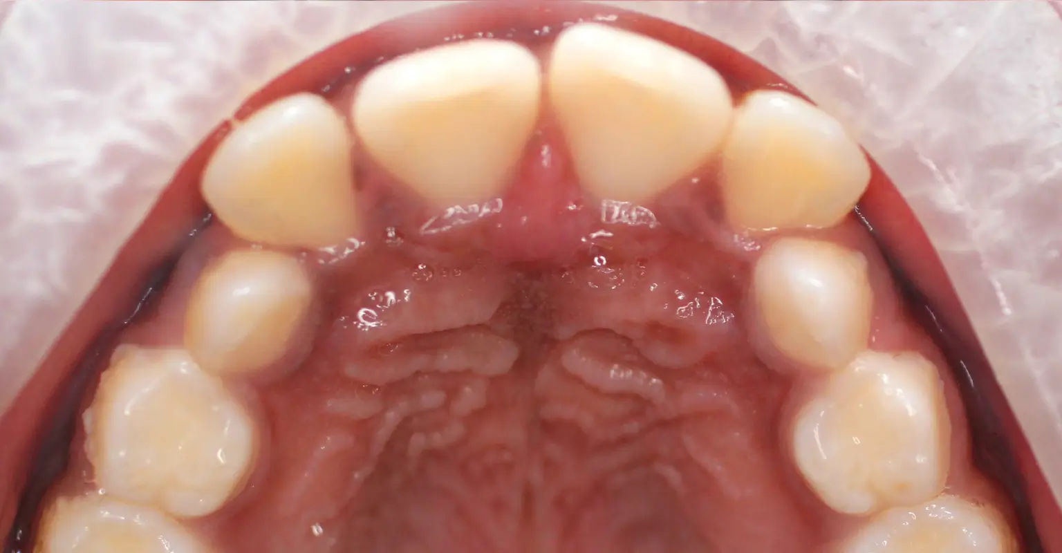 west-springs-orthodontist-airdrie-orthodontist-result-5-before