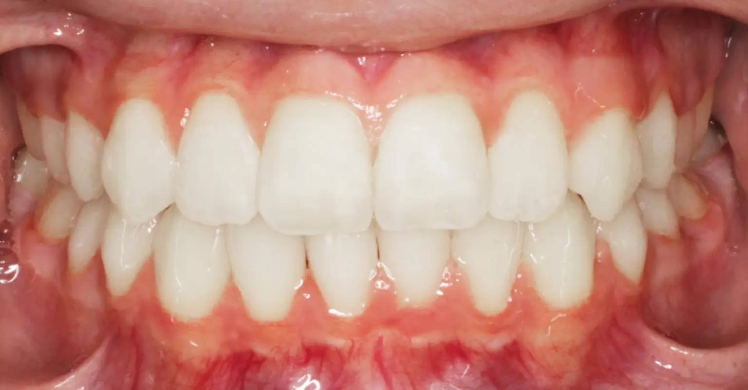 west-springs-orthodontist-airdrie-orthodontist-result-7-after