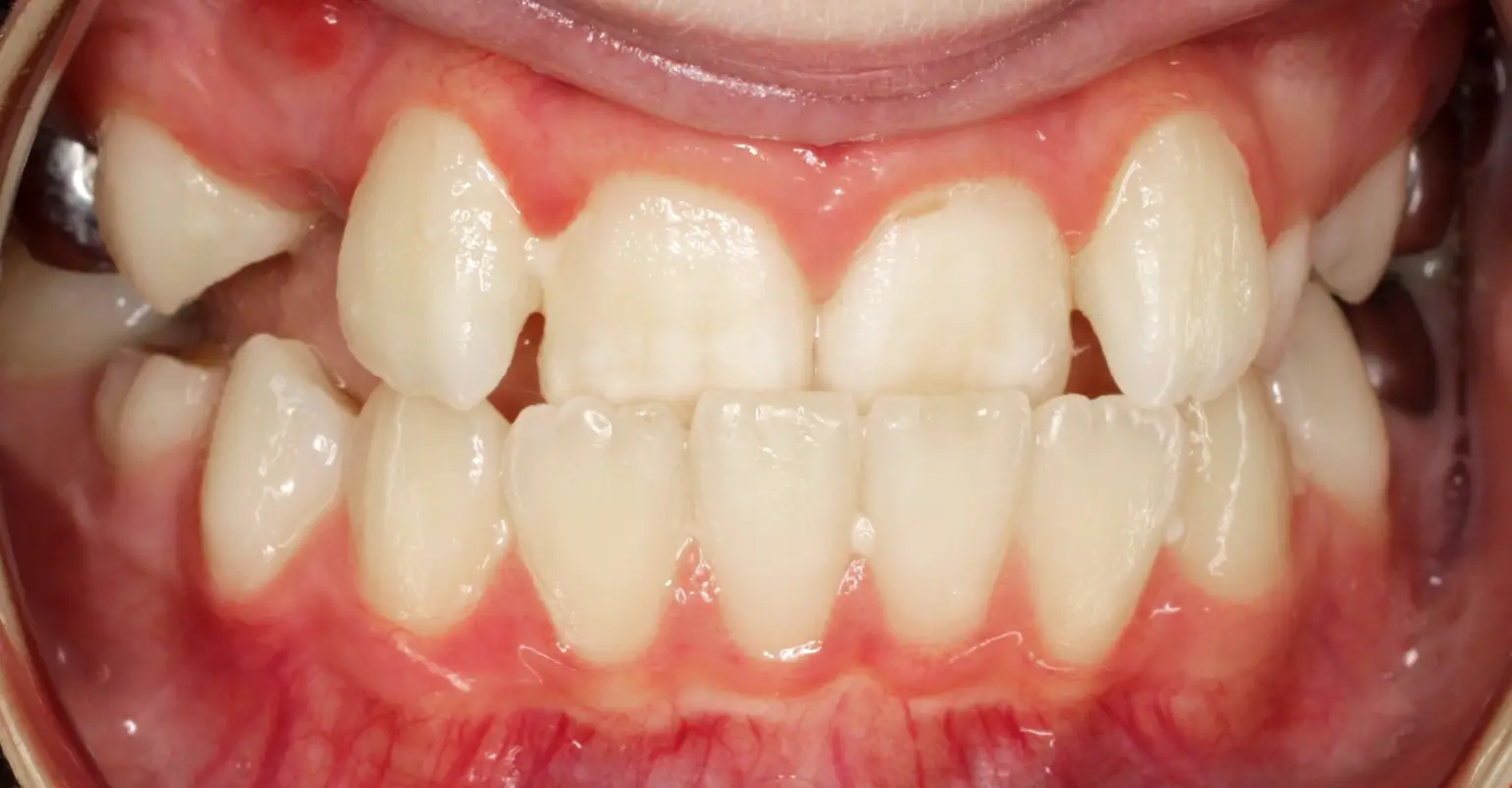 west-springs-orthodontist-airdrie-orthodontist-result-7-before