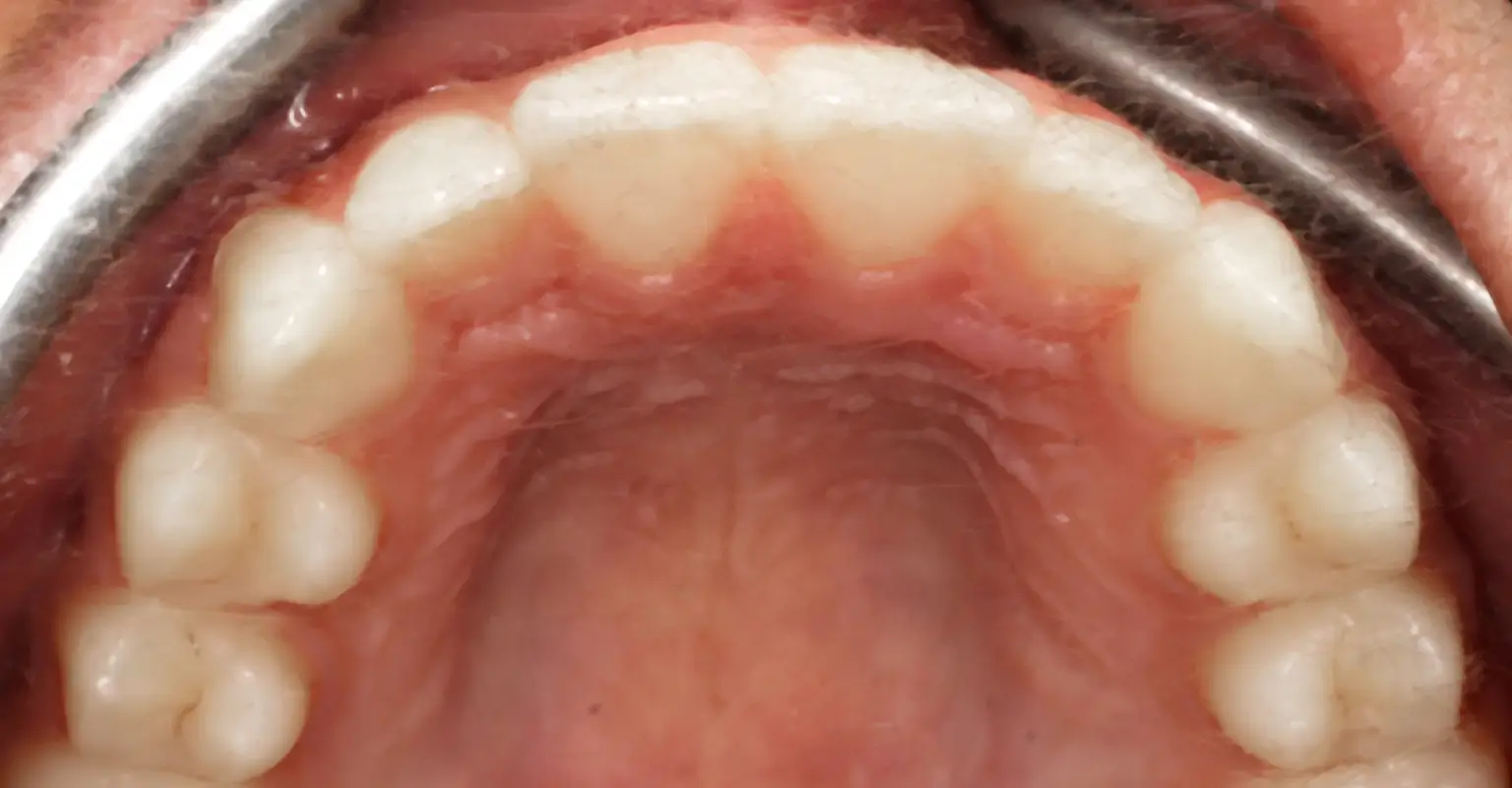 west-springs-orthodontist-airdrie-orthodontist-result-8-after
