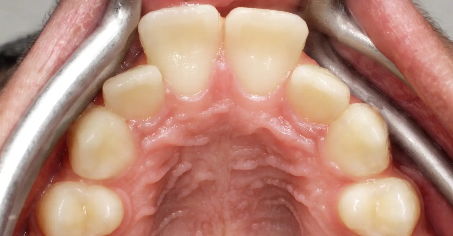 west-springs-orthodontist-airdrie-orthodontist-result-8-before