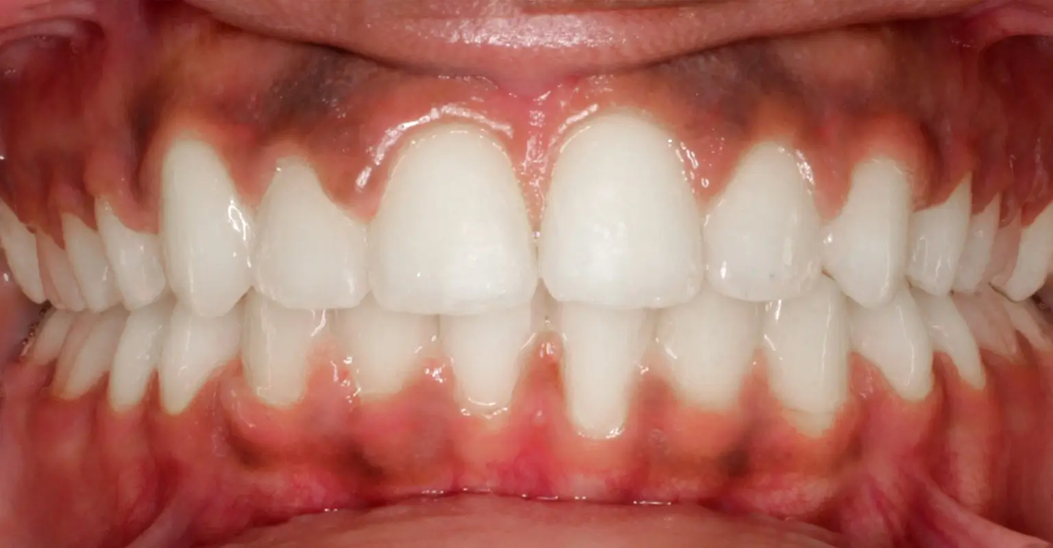 west-springs-orthodontist-airdrie-orthodontist-teen-orthodontics-after
