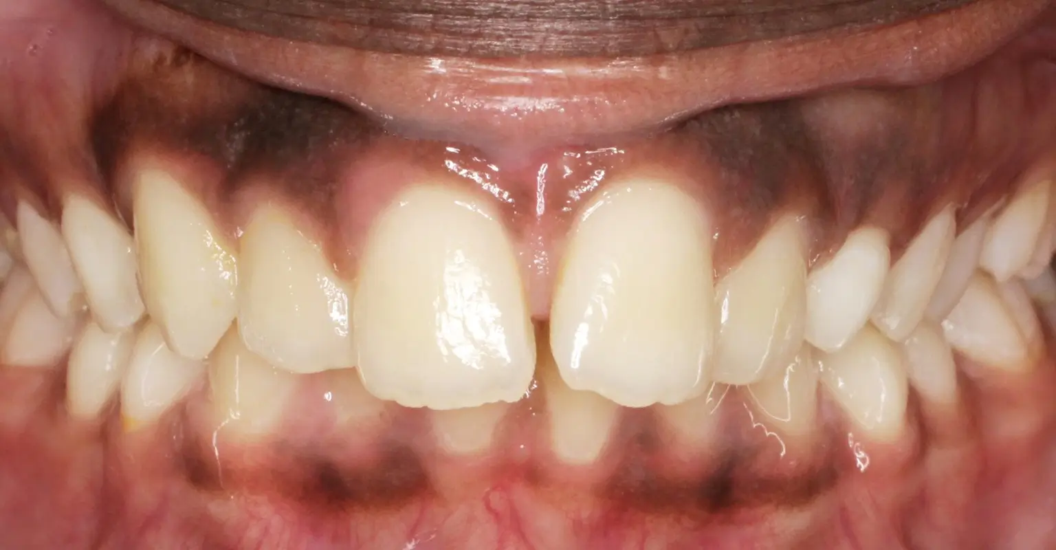 west-springs-orthodontist-airdrie-orthodontist-teen-orthodontics-before